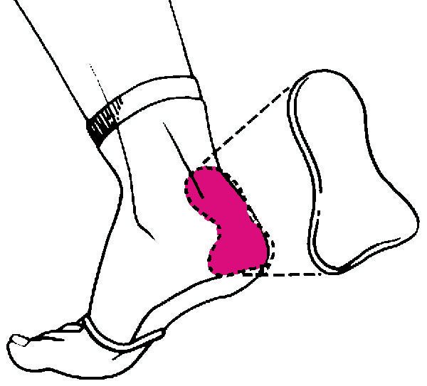 Achilles Heel Pad Sleeve (EC 8 Achilles)