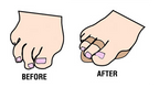 Budin Splint - Double Toe / Budin Splint - Single Toe — Dr. Jill’s Foot Pads