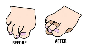 Budin Splint - Double Toe