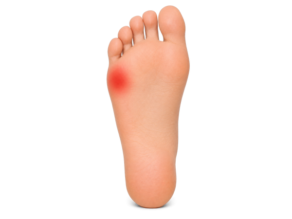 Sole of a foot with a callus spot highlighted