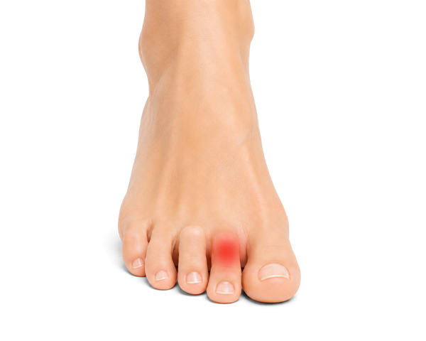Top of a foot with a corn on the second toe highlighted