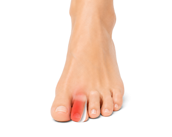 Top of a foot with a crooked second toe leaning over the big toe, highlighted