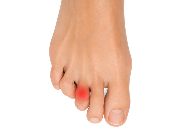 Top of a foot with a hammer toe knuckle highlighted