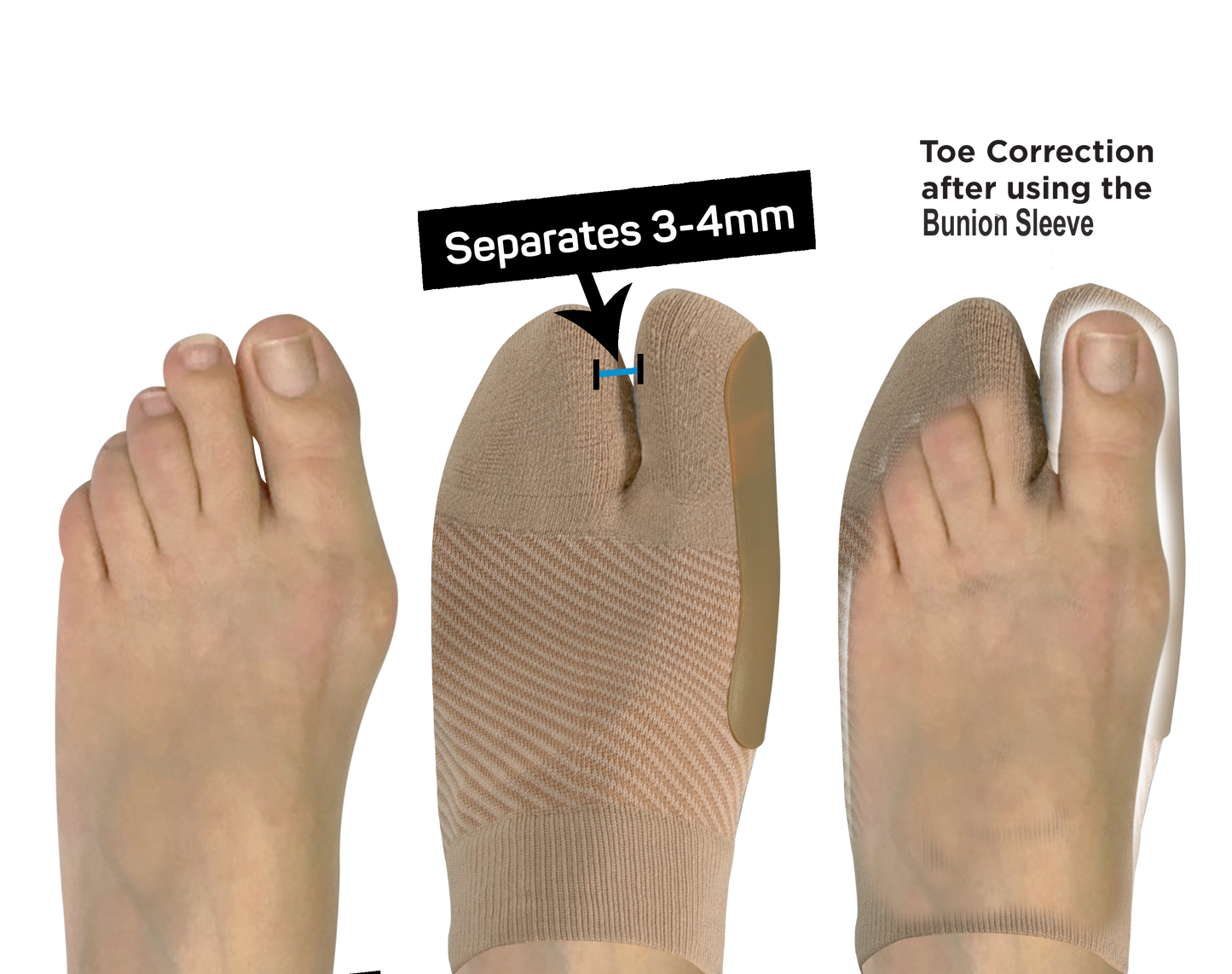 Bunion Bracing Sleeve