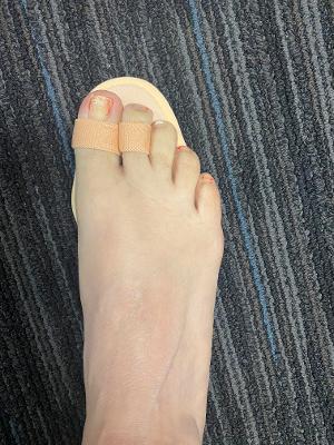 Budin Splint - Double Toe