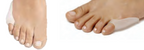 Tailor's Bunion Pad - Gel - EcoGel — view 5