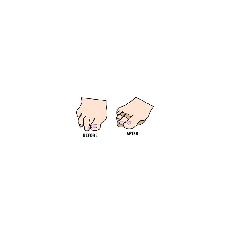 Budin Splint - Double Toe