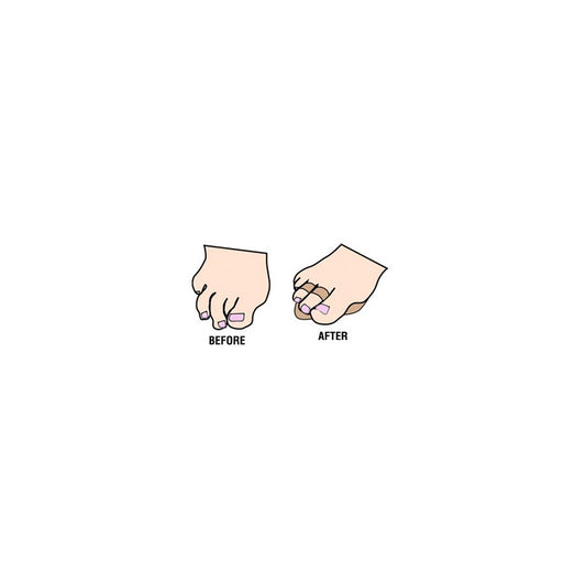 Budin Splint - Double Toe