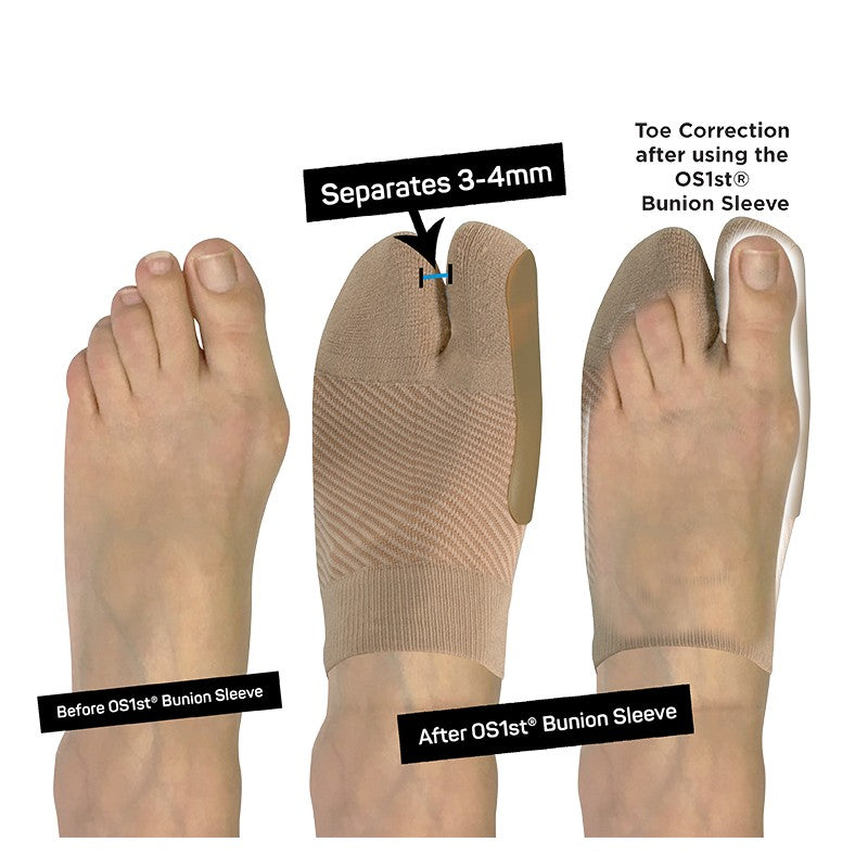 Bunion Bracing Sleeve